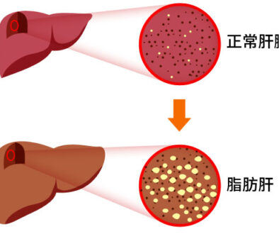 fattyliver-28052017