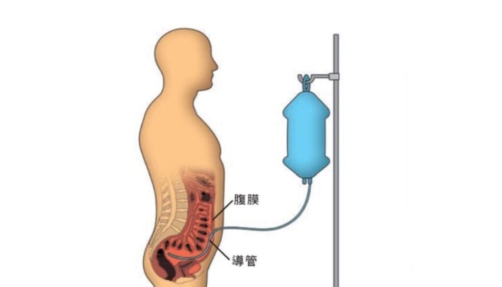 dialysis-032008