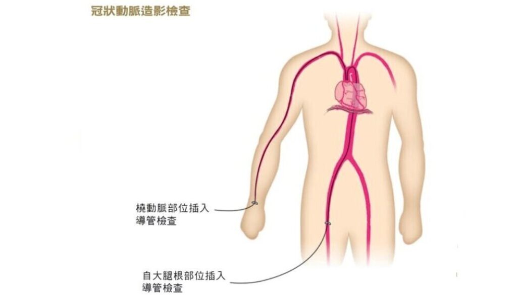 coronaryangiogram-062007