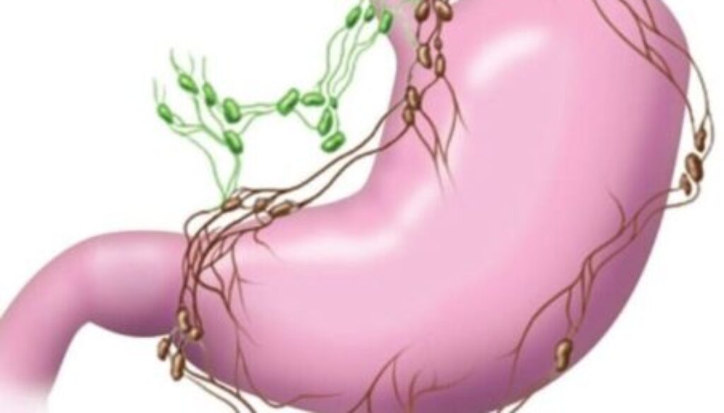 gastriccancer-122006-a