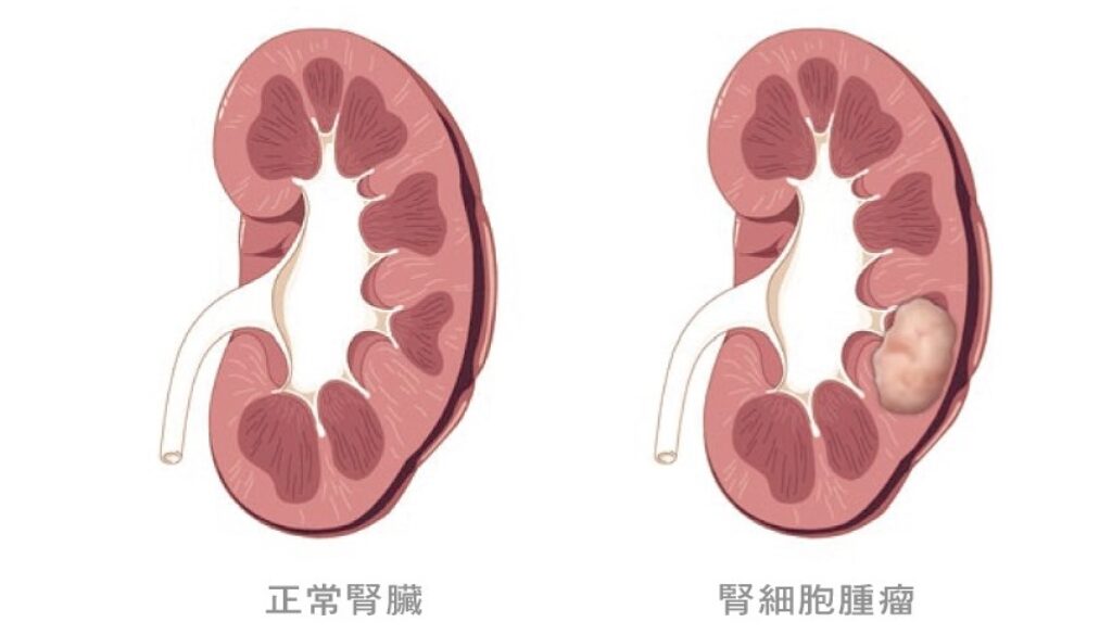 kidney tumor