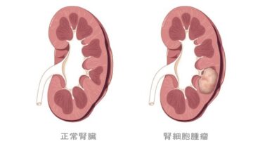 kidney tumor