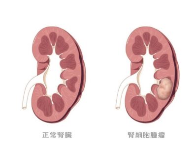 kidney tumor