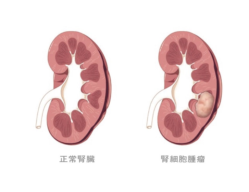 kidney tumor