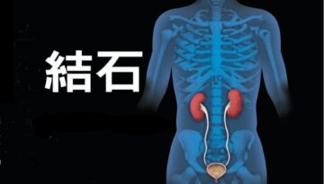 urolithiasis_032008