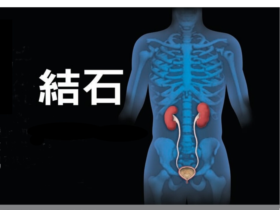 urolithiasis_032008